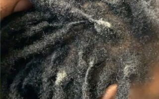 Featured-Image-of-How-to-Treat-Dandruff-with-Locs-showing-Picture-of-a-woman-that-has-whitish-dandruff-in-her-locs