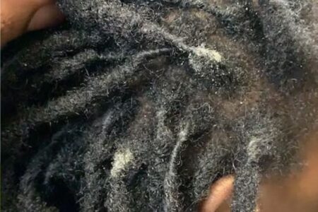 Featured-Image-of-How-to-Treat-Dandruff-with-Locs-showing-Picture-of-a-woman-that-has-whitish-dandruff-in-her-locs