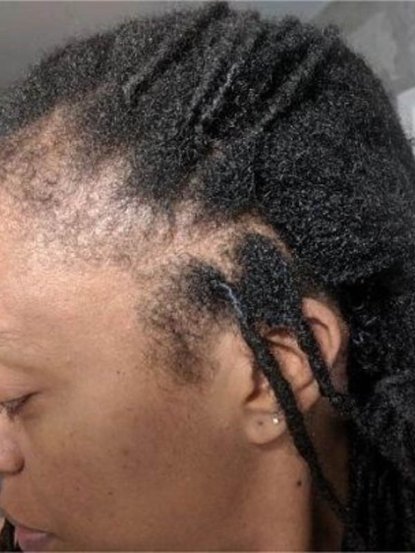 Thin-locs