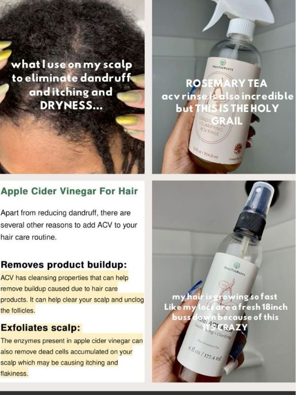 How-to-treat-dandruff.